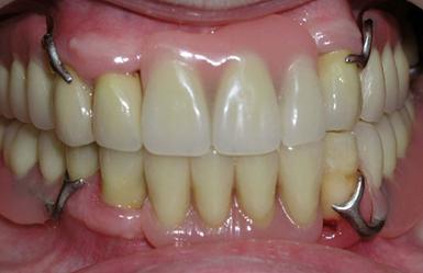 Зубной протез с кламмерами