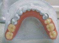 Частично съемный протез для ряда зубов