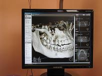 снимок челюсти человека на компьютере