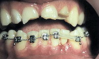 Частичная несъемная ортодонтическая аппаратура