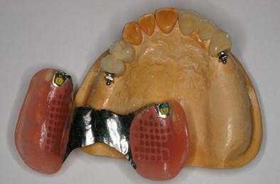 Бюгельный протез зубов на аттачменах