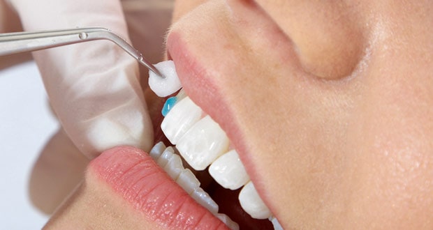процедура прикрепления винира к переднему зубу