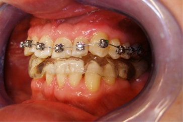 Ортодонтическая конструкция