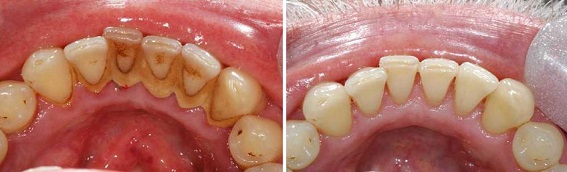 Снятие зубных отложений Томск Тупиковый мед томск стоматология
